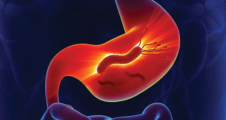 Identifying and Eradicating H.pylori