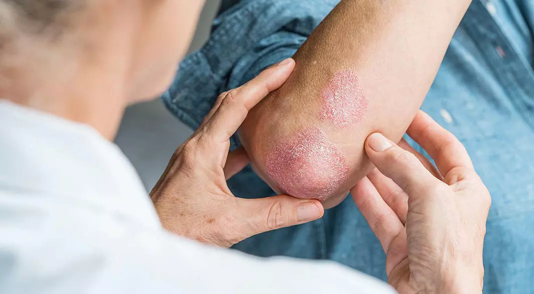 Psoriasis 101: A Guide for Primary Care Physicians