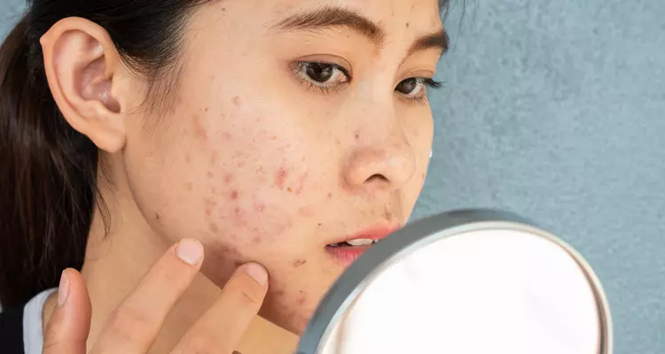 Exploring the Prevalence of Antibiotic Use in Acne Treatment and Non-Antibiotic Solutions 