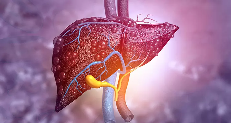 The impact of the ANSWER study on the economic burden of liver cirrhosis