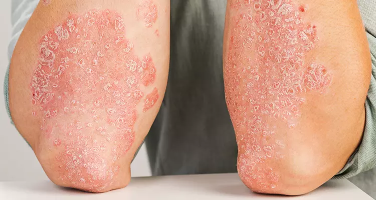 The Future Direction of Topical Psoriasis Treatment to Improve Patient Outcomes