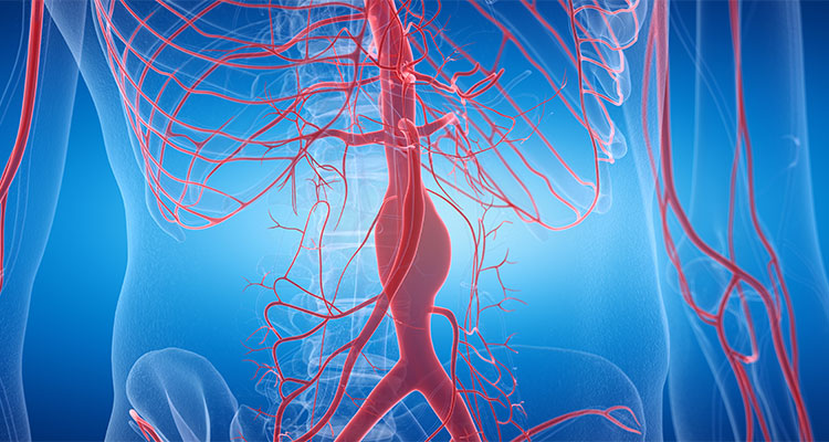 Aortic Aneurysms: Keeping Watch Before They Rupture