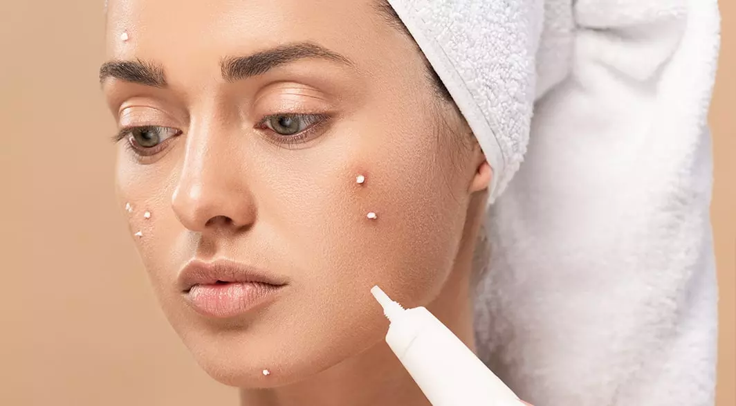 A Primary Care Guide on Pimples: Topical Therapies for Acne