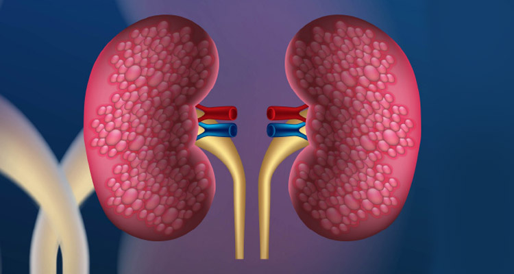 Management of CKD and Options for Renal Replacement Therapy