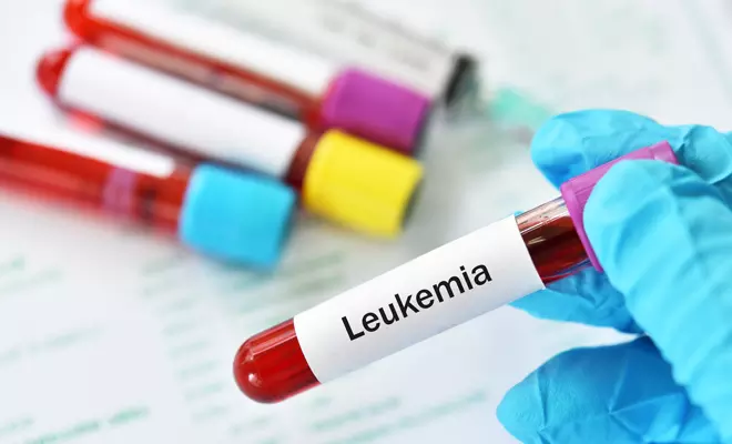Acute Leukemia - Immunophenotyping