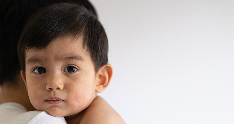 An Approach to Fever and Rash in Children 