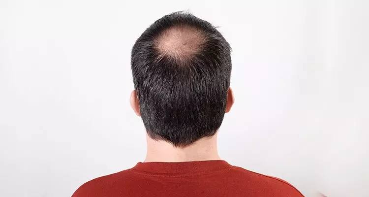Understanding Hair Loss: An Overview on Alopecia