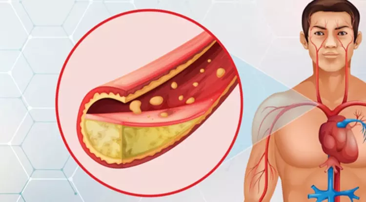 Better Together: Using Combination Therapy in the Intensive Lowering of LDL-C in Dyslipidemia