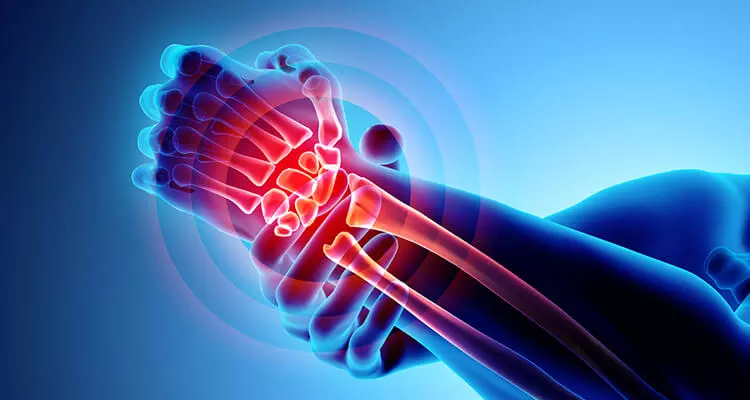 Managing pain in OA: A concise review of COX-2 selective NSAIDs